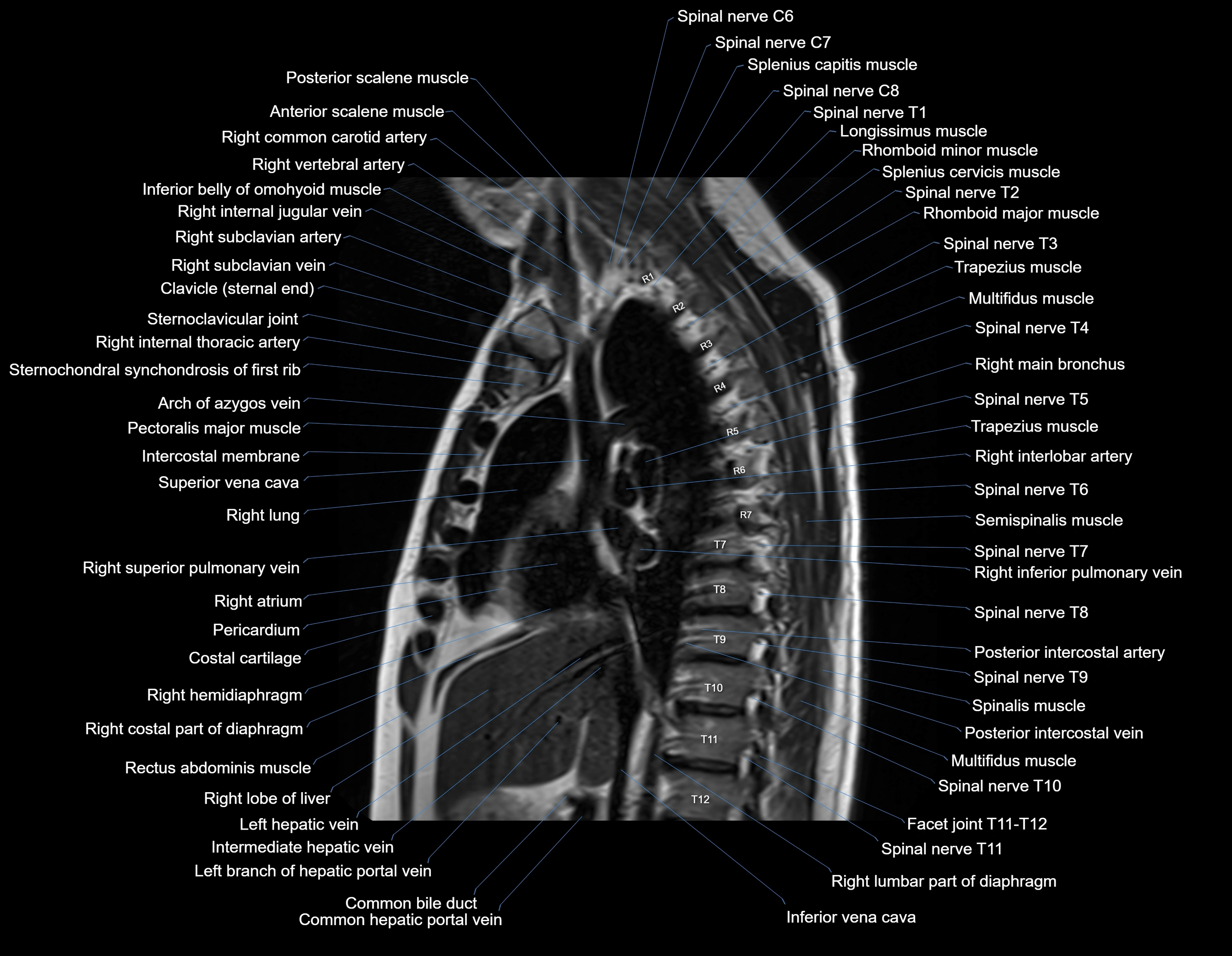 MRI chest (thorax) sagittal labelled cross sectional anatomy 3T radiology image-img-00001-00017.webp